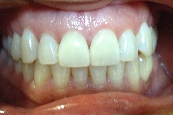 Dental Veneers after at Birch Dental in Newport Beach, CA