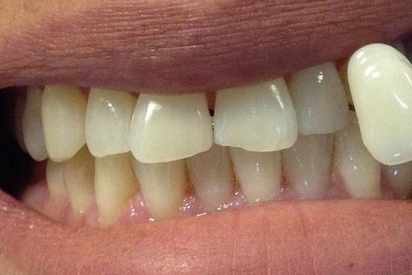 Dental Veneers before at Birch Dental in Newport Beach, CA