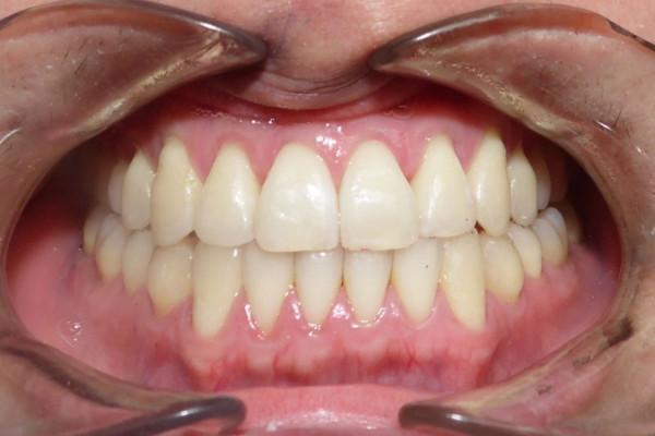 Invisalign after at Birch Dental in Newport Beach, CA