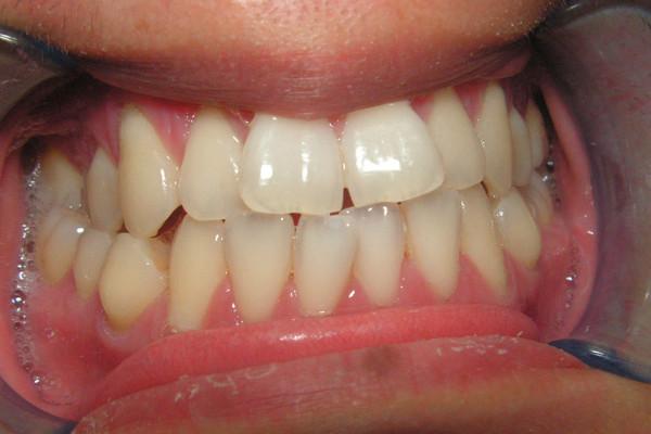 Invisalign before at Birch Dental in Newport Beach, CA
