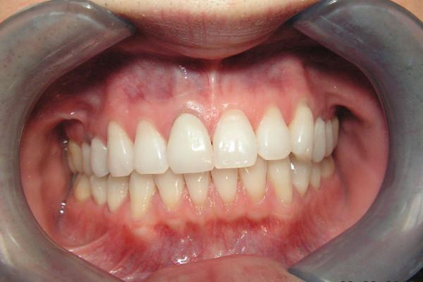 Dental Crowns after at Birch Dental in Newport Beach, CA