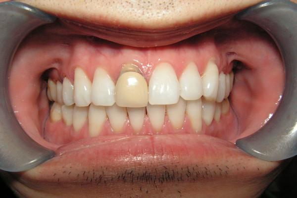Dental Crowns before at Birch Dental in Newport Beach, CA