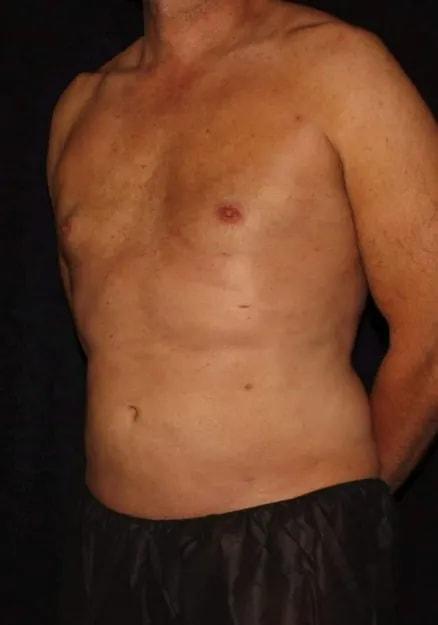 Liposuction after at Silk Touch Cosmetic Surgery & Medspa in Boise, ID