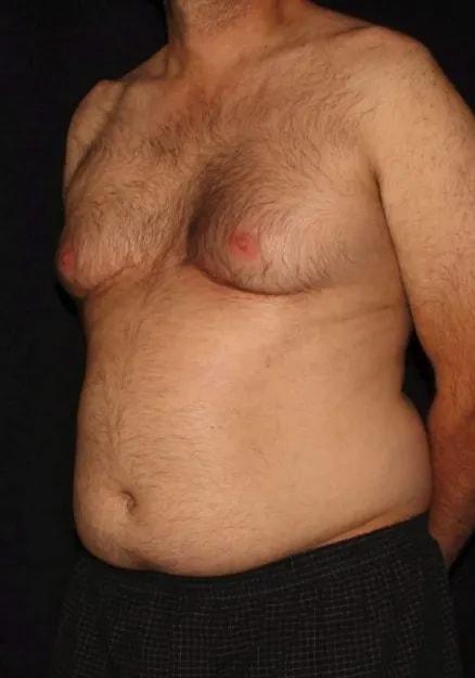 Liposuction before at Silk Touch Cosmetic Surgery & Medspa in Boise, ID