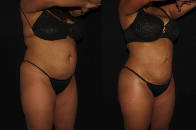Brazilian Butt Lift result at Silk Touch Cosmetic Surgery & Medspa in Boise, ID
