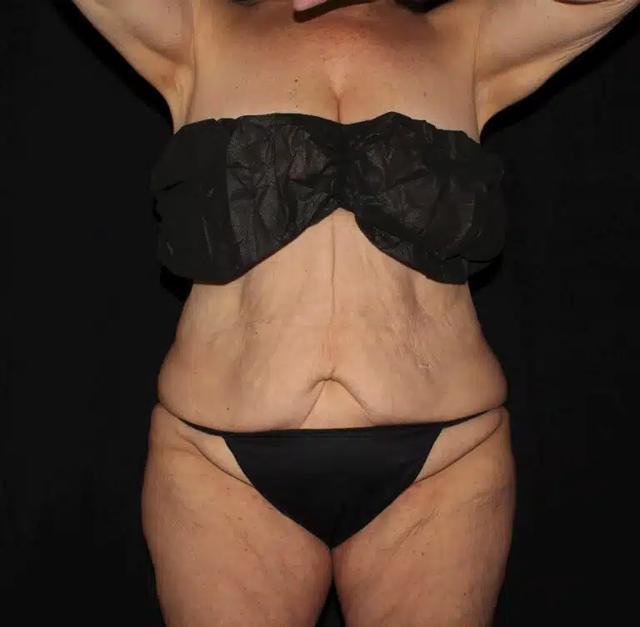 Mommy Makeover before at Silk Touch Cosmetic Surgery & Medspa in Boise, ID
