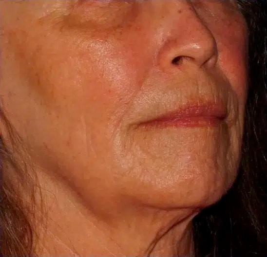 Morpheus8 after at Silk Touch Cosmetic Surgery & Medspa in Boise, ID