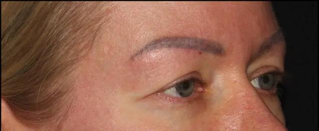 Laser Skin Resurfacing before at Silk Touch Cosmetic Surgery & Medspa in Boise, ID