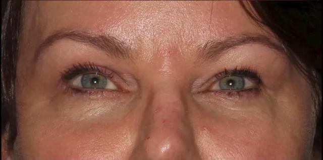Blepharoplasty after at Silk Touch Cosmetic Surgery & Medspa in Boise, ID