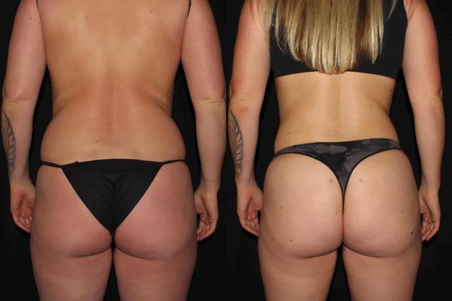Brazilian Butt Lift result at Silk Touch Cosmetic Surgery & Medspa in Boise, ID