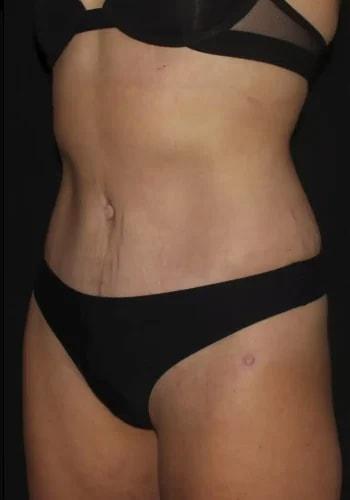 Silk Touch Cosmetic Surgery & Medspa tummy tuck after — Boise, ID