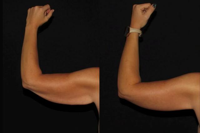 Arm Lift result at Silk Touch Cosmetic Surgery & Medspa in Boise, ID