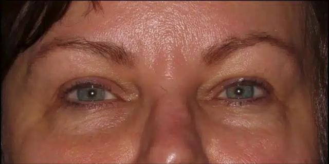 Blepharoplasty before at Silk Touch Cosmetic Surgery & Medspa in Boise, ID