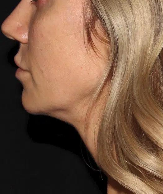 Chin Implant before at Silk Touch Cosmetic Surgery & Medspa in Boise, ID