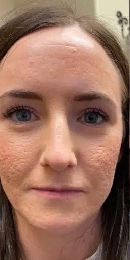 Morpheus8 before at Silk Touch Cosmetic Surgery & Medspa in Boise, ID