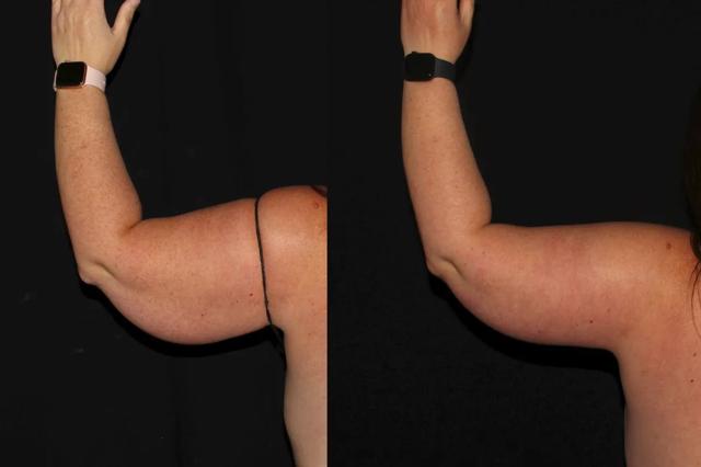 Arm Lift result at Silk Touch Cosmetic Surgery & Medspa in Boise, ID