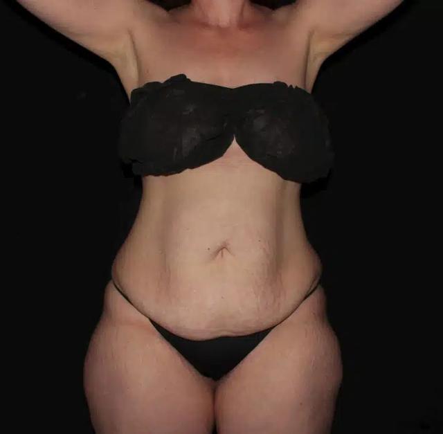 Mommy Makeover before at Silk Touch Cosmetic Surgery & Medspa in Boise, ID