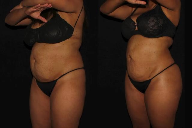 Brazilian Butt Lift result at Silk Touch Cosmetic Surgery & Medspa in Boise, ID