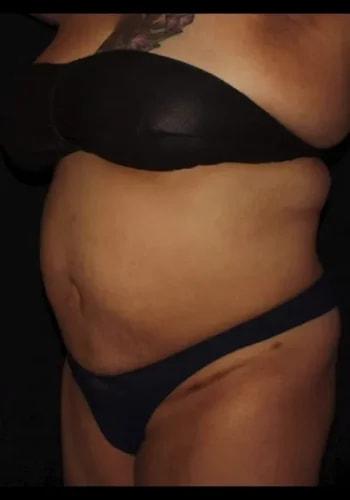 Liposuction after at Silk Touch Cosmetic Surgery & Medspa in Boise, ID