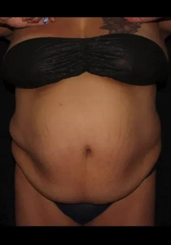 Liposuction before at Silk Touch Cosmetic Surgery & Medspa in Boise, ID