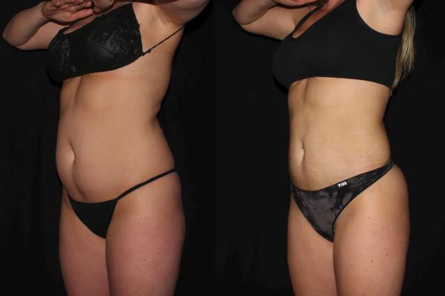Brazilian Butt Lift result at Silk Touch Cosmetic Surgery & Medspa in Boise, ID