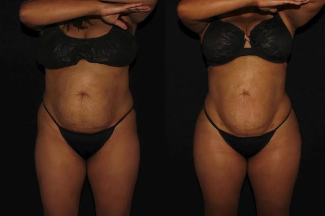 Brazilian Butt Lift result at Silk Touch Cosmetic Surgery & Medspa in Boise, ID