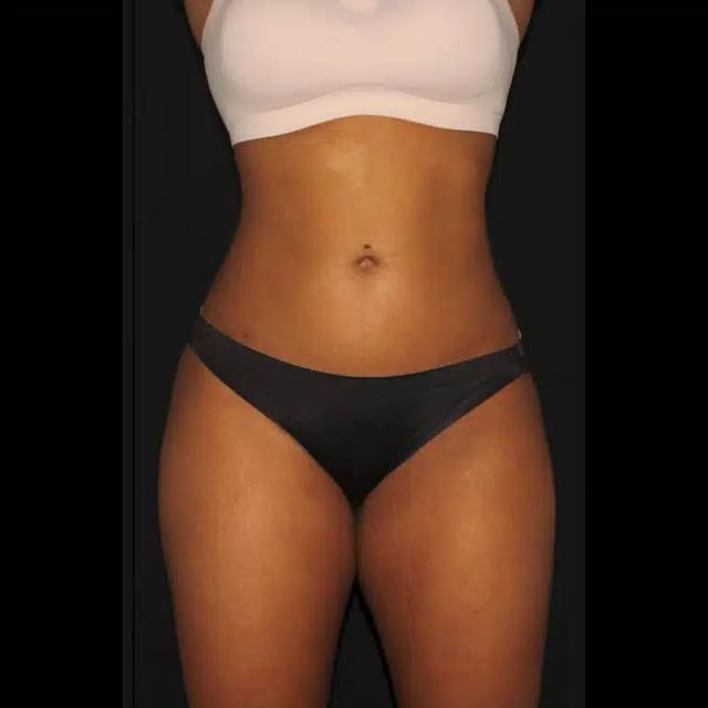 Brazilian Butt Lift after at Silk Touch Cosmetic Surgery & Medspa in Boise, ID