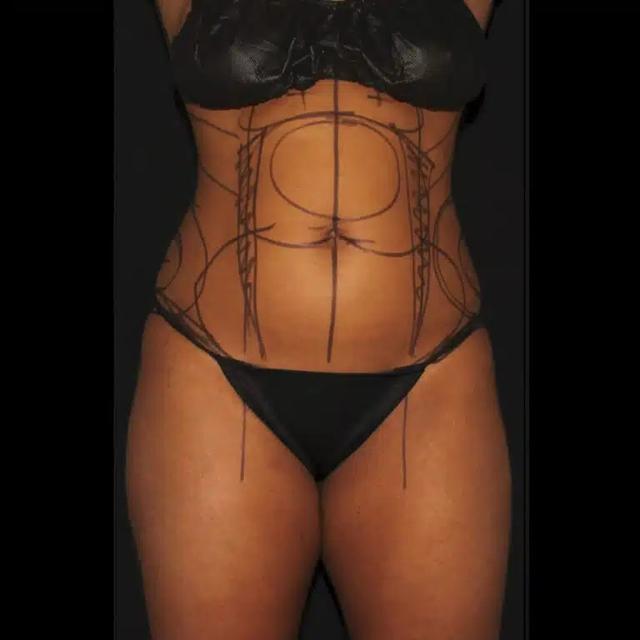 Brazilian Butt Lift before at Silk Touch Cosmetic Surgery & Medspa in Boise, ID