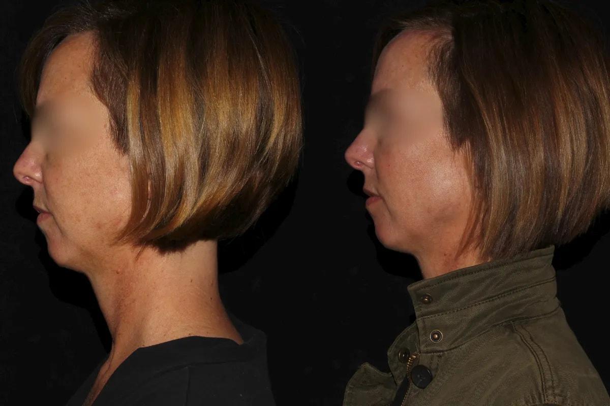 Silk Touch Cosmetic Surgery & Medspa chin implant result — Boise, ID