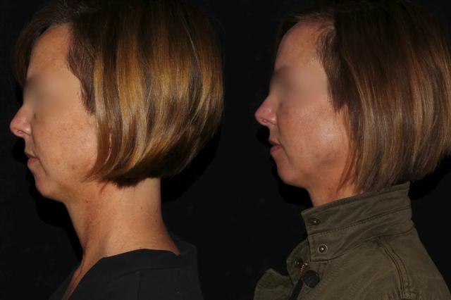 Chin Implant result at Silk Touch Cosmetic Surgery & Medspa in Boise, ID
