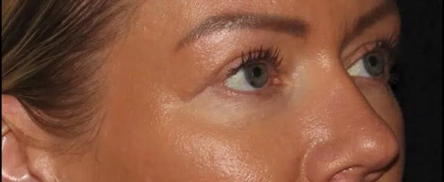 Laser Skin Resurfacing after at Silk Touch Cosmetic Surgery & Medspa in Boise, ID