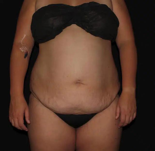 Mini Tummy Tuck before at Silk Touch Cosmetic Surgery & Medspa in Boise, ID