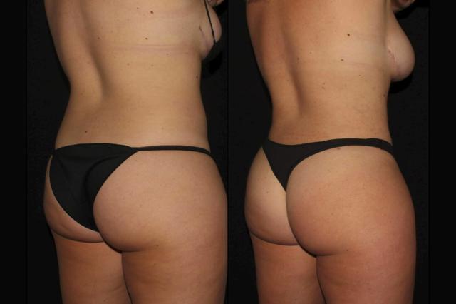 Brazilian Butt Lift result at Silk Touch Cosmetic Surgery & Medspa in Boise, ID