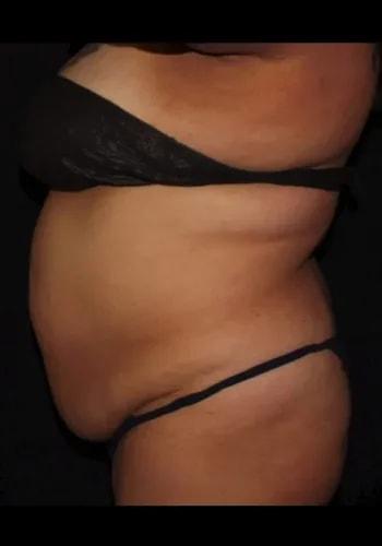 Liposuction before at Silk Touch Cosmetic Surgery & Medspa in Boise, ID
