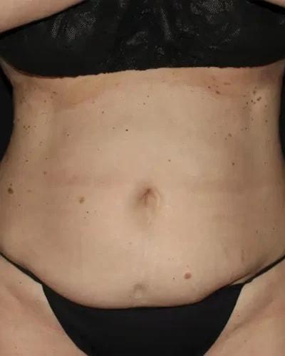 Mini Tummy Tuck before at Silk Touch Cosmetic Surgery & Medspa in Boise, ID