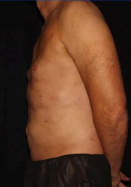 Liposuction after at Silk Touch Cosmetic Surgery & Medspa in Boise, ID