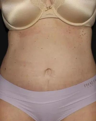 Silk Touch Cosmetic Surgery & Medspa tummy tuck after — Boise, ID