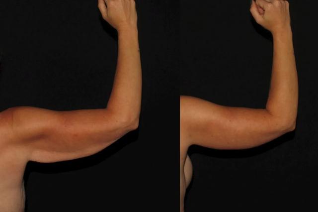 Arm Lift result at Silk Touch Cosmetic Surgery & Medspa in Boise, ID
