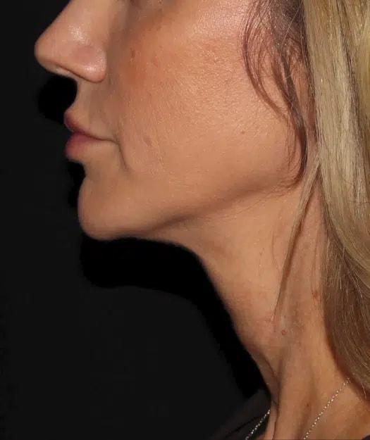 Silk Touch Cosmetic Surgery & Medspa chin implant after — Boise, ID