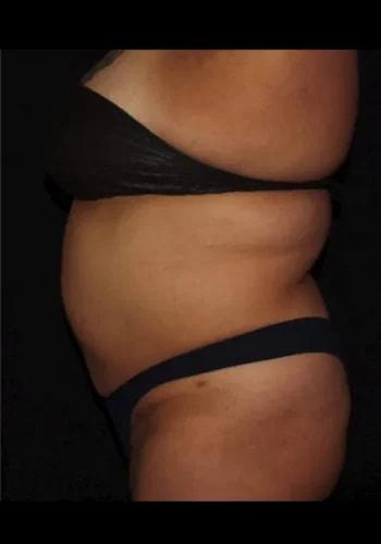Liposuction after at Silk Touch Cosmetic Surgery & Medspa in Boise, ID