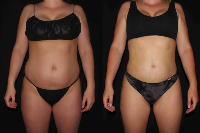 Brazilian Butt Lift result at Silk Touch Cosmetic Surgery & Medspa in Boise, ID