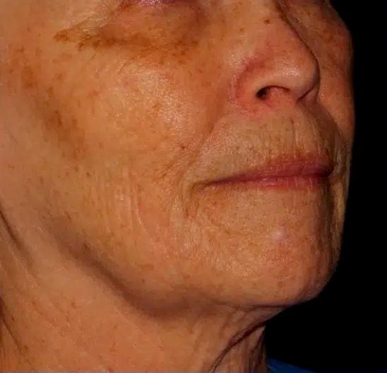 Morpheus8 before at Silk Touch Cosmetic Surgery & Medspa in Boise, ID