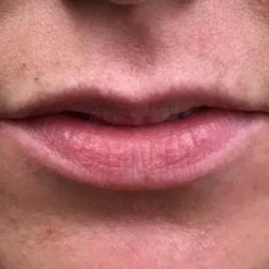 Juvederm before at Silk Touch Cosmetic Surgery & Medspa in Boise, ID