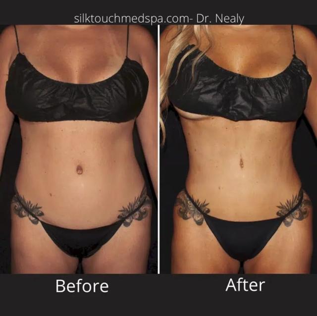 Liposuction result at Silk Touch Cosmetic Surgery & Medspa in Boise, ID