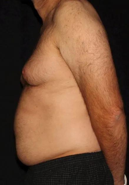 Liposuction before at Silk Touch Cosmetic Surgery & Medspa in Boise, ID