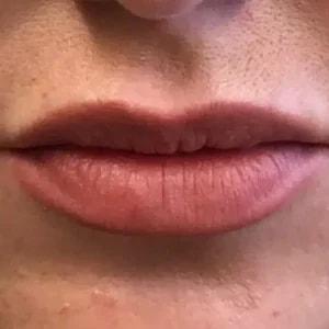 Juvederm after at Silk Touch Cosmetic Surgery & Medspa in Boise, ID
