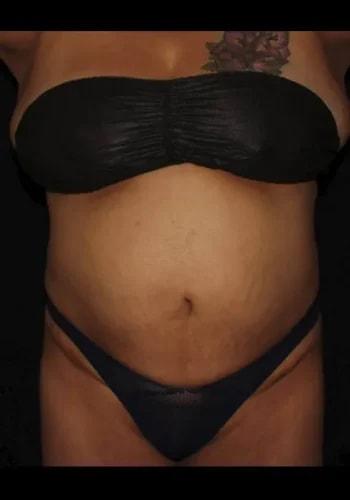 Liposuction after at Silk Touch Cosmetic Surgery & Medspa in Boise, ID
