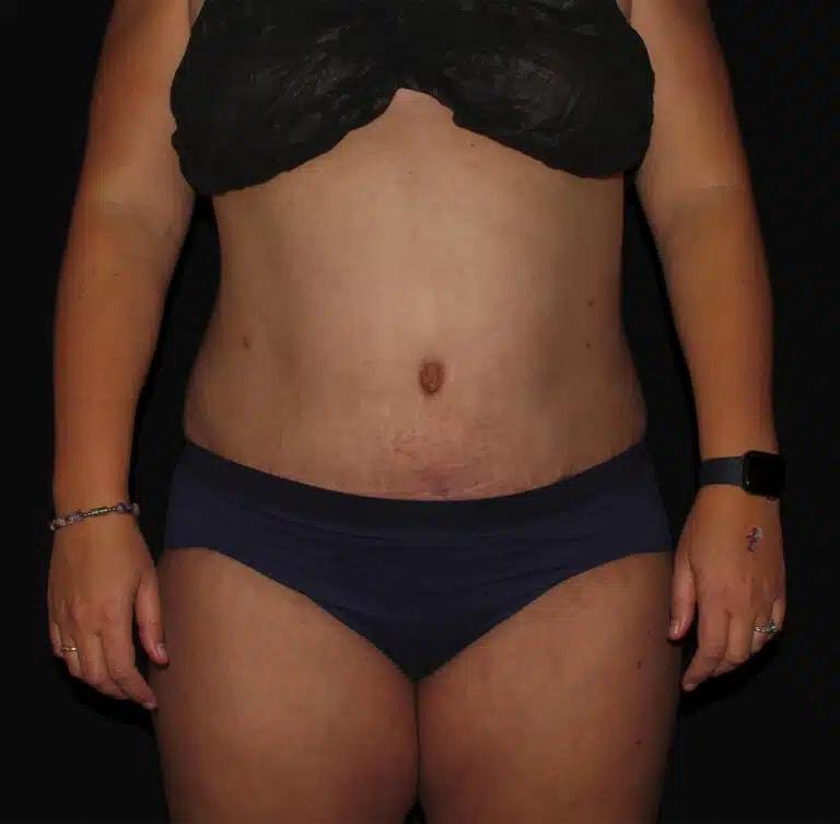 Silk Touch Cosmetic Surgery & Medspa tummy tuck after — Boise, ID
