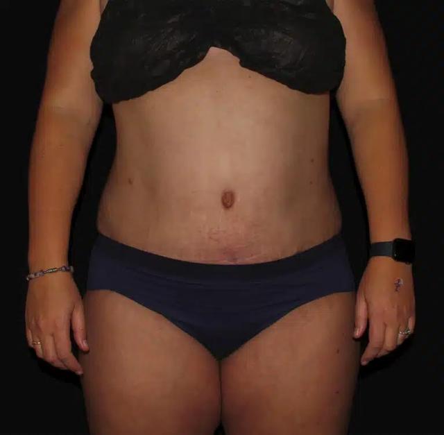 Mini Tummy Tuck after at Silk Touch Cosmetic Surgery & Medspa in Boise, ID