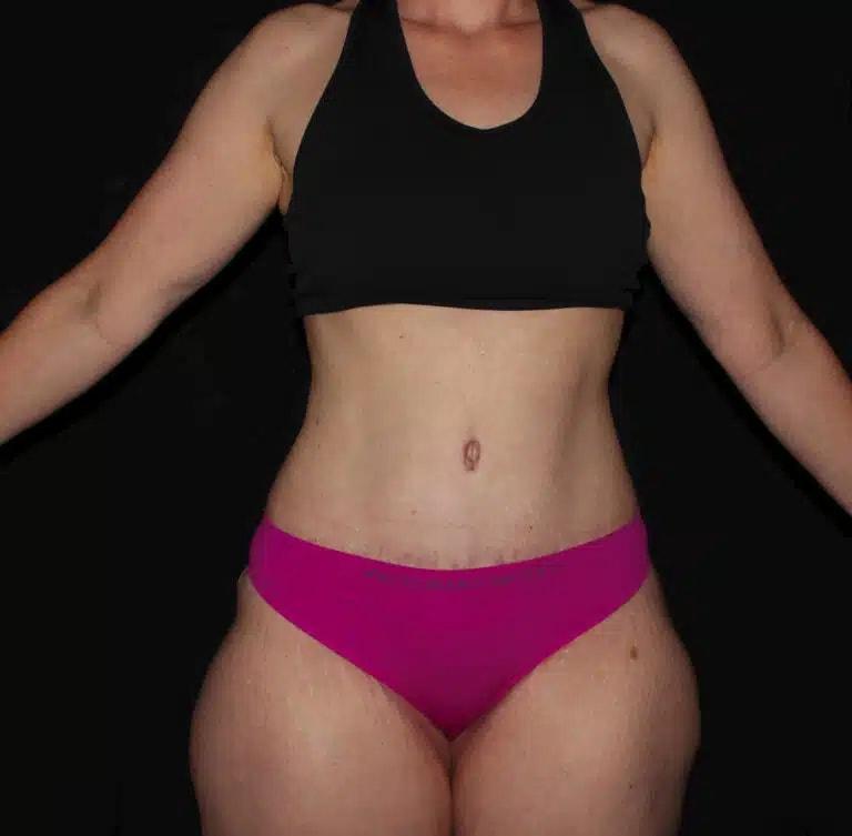 Silk Touch Cosmetic Surgery & Medspa tummy tuck after — Boise, ID